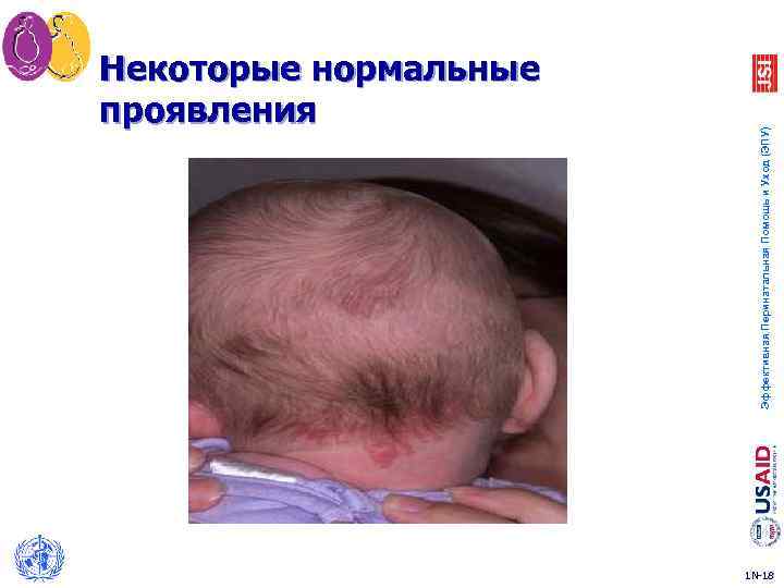 Эффективная Перинатальная Помощь и Уход (ЭПУ) Некоторые нормальные проявления 1 N-18 