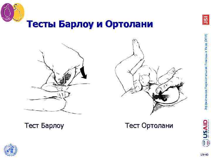 Эффективная Перинатальная Помощь и Уход (ЭПУ) Тесты Барлоу и Ортолани Тест Барлоу Тест Ортолани