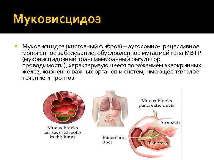 Муковисцидоз моногенное заболевание возникающее в результате. Муковисцидоз аутосомно-рецессивное заболевание. Муковисцидоз кистозный фиброз. Генетическое заболевание муковисцидоз. Муковисцидоз презентация.