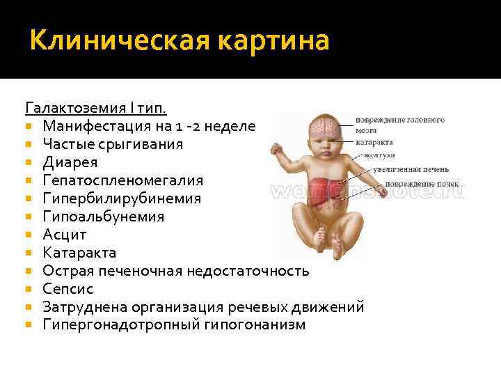Клиническая картина Галактоземия I тип. Манифестация на 1 -2 неделе Частые срыгивания Диарея Гепатоспленомегалия