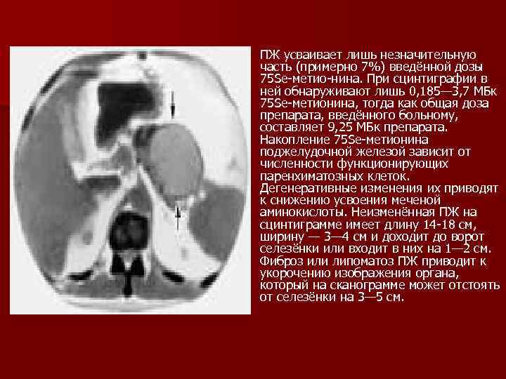 ПЖ усваивает лишь незначительную часть (примерно 7%) введённой дозы 75 Sе-метио-нина. При сцинтиграфии в