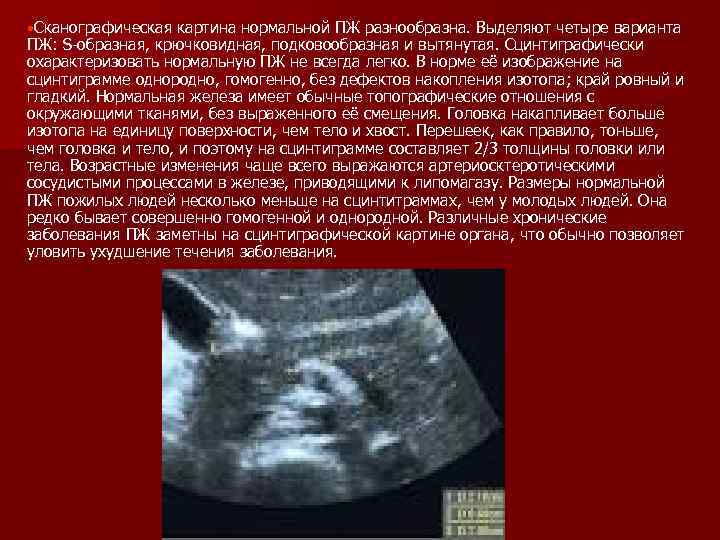  Сканографическая картина нормальной ПЖ разнообразна. Выделяют четыре варианта ПЖ: S-образная, крючковидная, подковообразная и