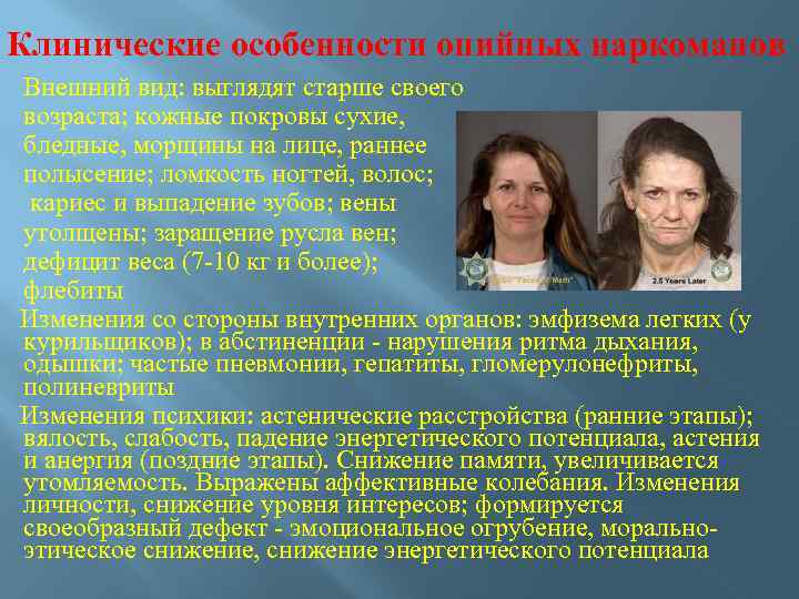 Клинические особенности опийных наркоманов Внешний вид: выглядят старше своего возраста; кожные покровы сухие, бледные,