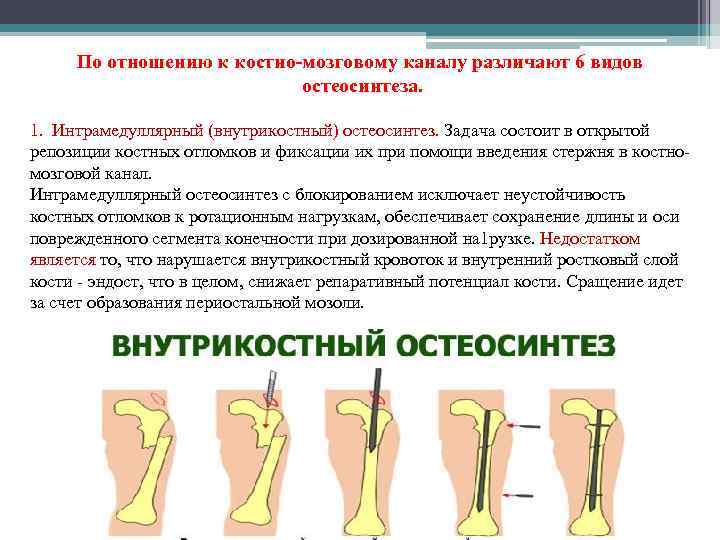 По отношению к костно-мозговому каналу различают 6 видов остеосинтеза. 1. Интрамедуллярный (внутрикостный) остеосинтез. Задача