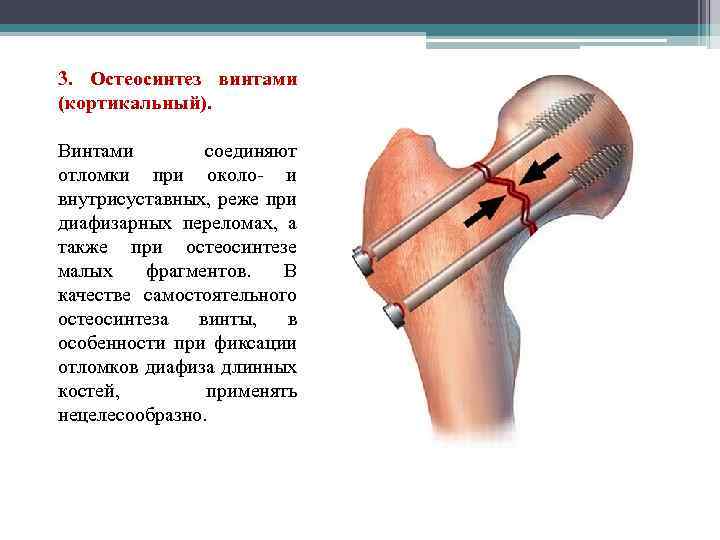 3. Остеосинтез винтами (кортикальный). Винтами соединяют отломки при около- и внутрисуставных, реже при диафизарных