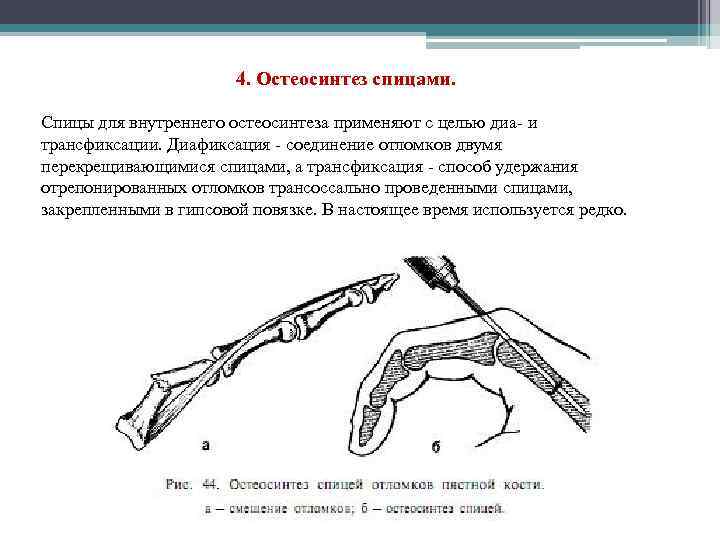 4. Остеосинтез спицами. Спицы для внутреннего остеосинтеза применяют с целью диа- и трансфиксации. Диафиксация