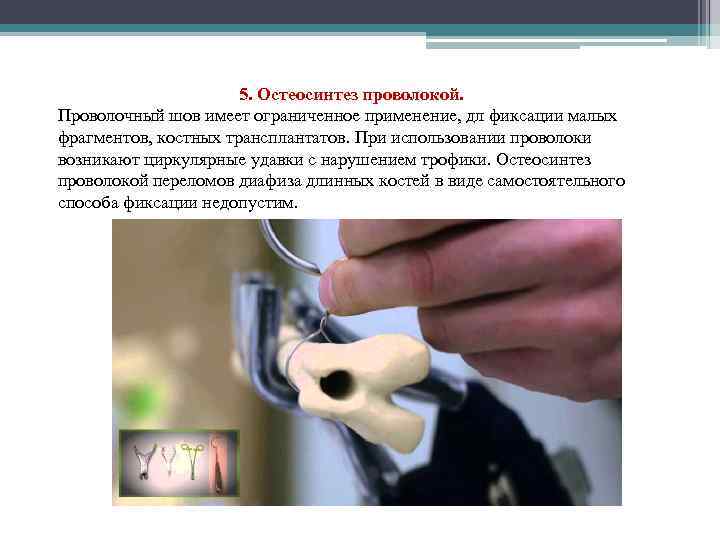 5. Остеосинтез проволокой. Проволочный шов имеет ограниченное применение, дл фиксации малых фрагментов, костных трансплантатов.