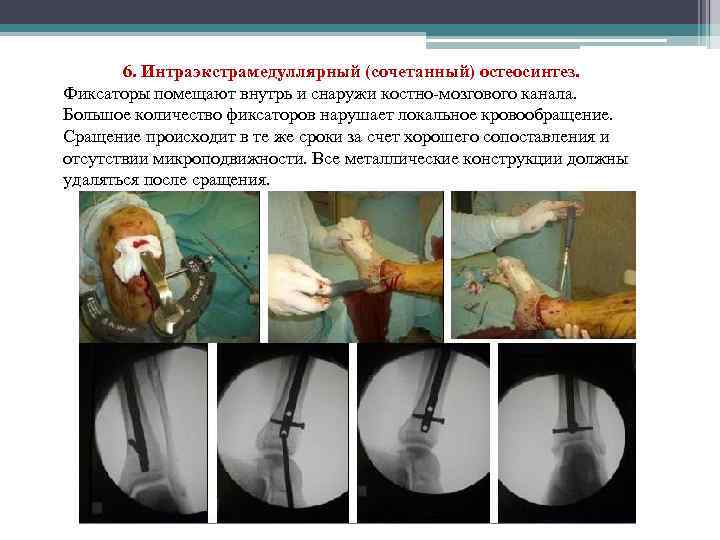 6. Интраэкстрамедуллярный (сочетанный) остеосинтез. Фиксаторы помещают внутрь и снаружи костно-мозгового канала. Большое количество фиксаторов