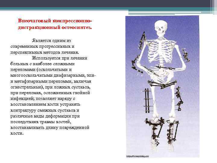  Внеочаговый компрессионнодистракционный остеосинтез. Является одним из современных прогрессивных и перспективных методов лечения. Используется
