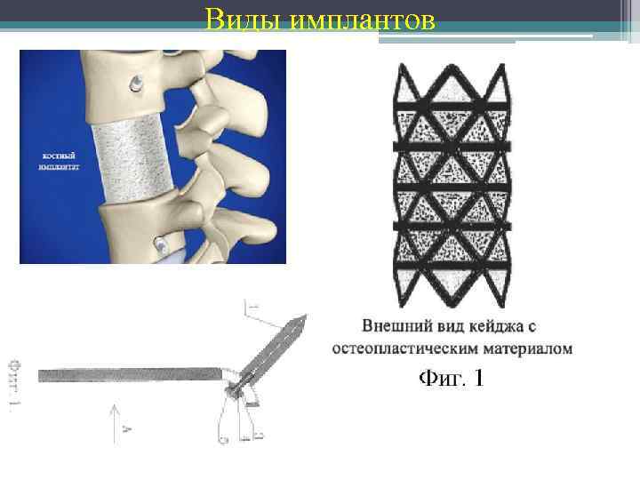 Виды имплантов 