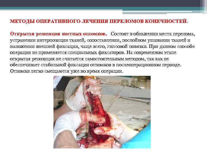 МЕТОДЫ ОПЕРАТИВНОГО ЛЕЧЕНИЯ ПЕРЕЛОМОВ КОНЕЧНОСТЕЙ. Открытая репозиция костных отломков. Состоят в обнажении места перелома,