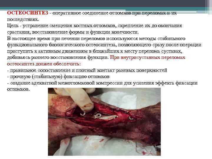 ОСТЕОСИНТЕЗ - оперативное соединение отломков при переломах и их последствиях. Цель - устранение смещения