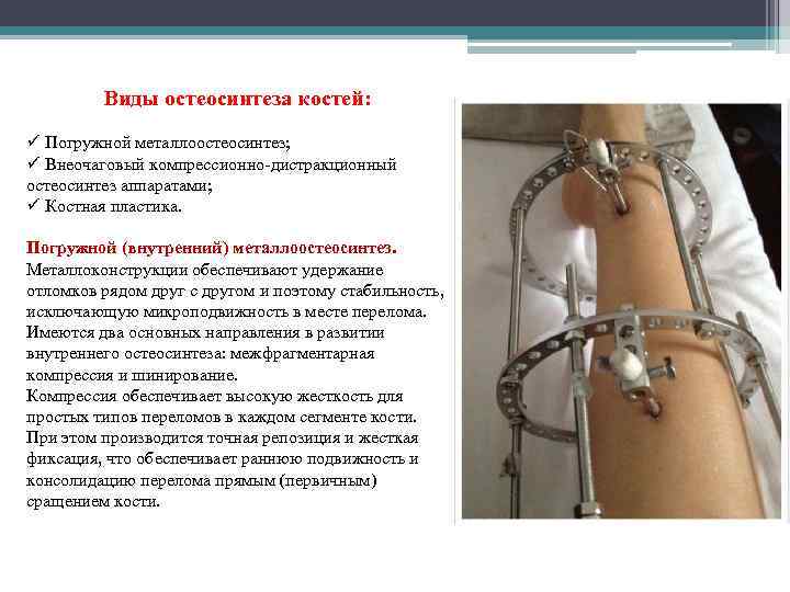 Виды остеосинтеза костей: ü Погружной металлоостеосинтез; ü Внеочаговый компрессионно-дистракционный остеосинтез аппаратами; ü Костная пластика.