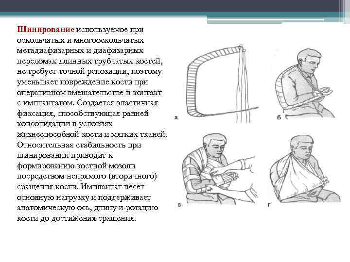 Шинирование используемое при оскольчатых и многооскольчатых метадиафизарных и диафизарных переломах длинных трубчатых костей, не