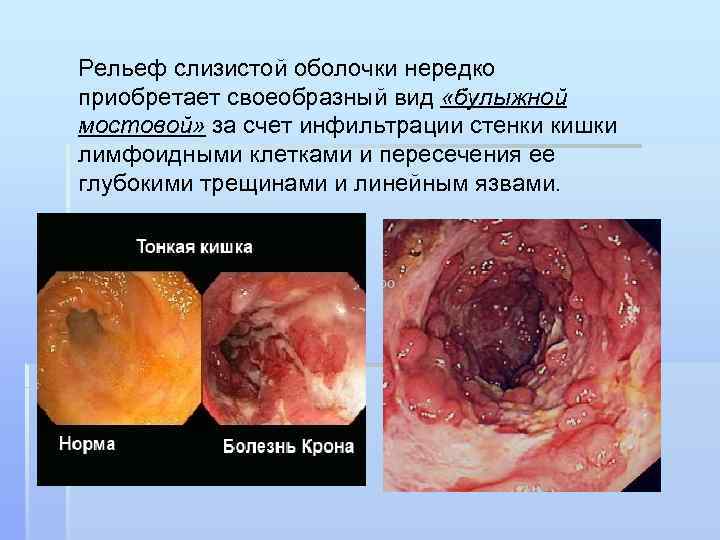 Рельеф слизистой оболочки нередко приобретает своеобразный вид «булыжной мостовой» за счет инфильтрации стенки кишки