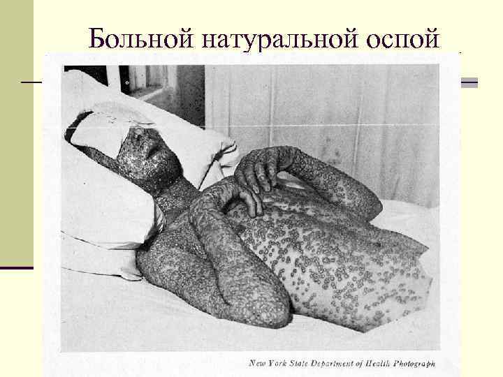Больной натуральной оспой 