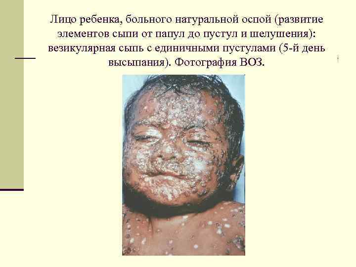 Лицо ребенка, больного натуральной оспой (развитие элементов сыпи от папул до пустул и шелушения):