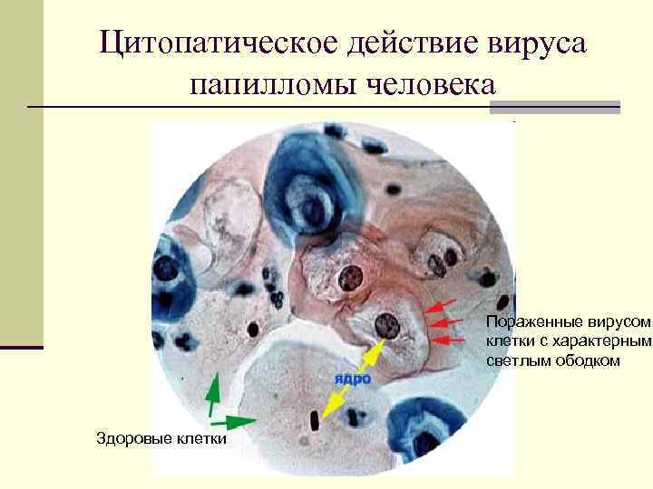 Цитопатическое действие вируса папилломы человека Пораженные вирусом клетки с характерным светлым ободком Здоровые клетки