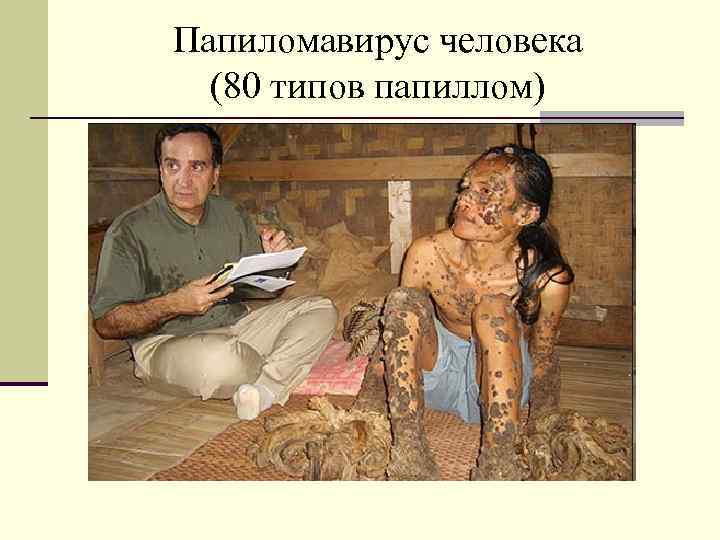 Папиломавирус человека (80 типов папиллом) 