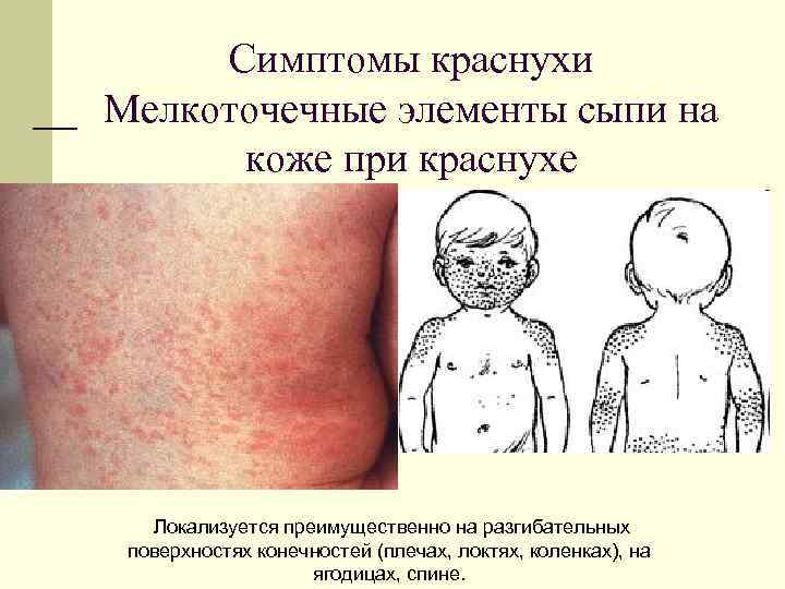 Симптомы краснухи Мелкоточечные элементы сыпи на коже при краснухе Локализуется преимущественно на разгибательных поверхностях