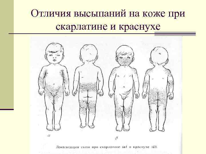 Отличия высыпаний на коже при скарлатине и краснухе 