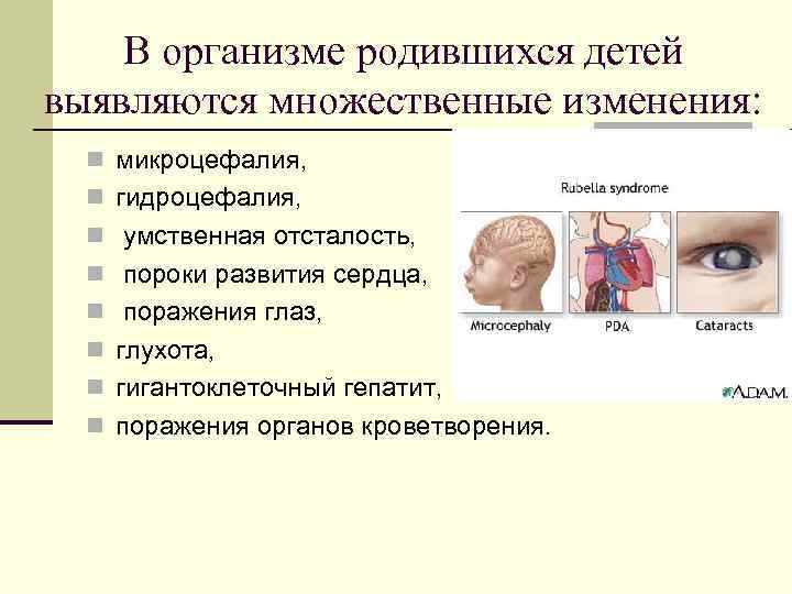 В организме родившихся детей выявляются множественные изменения: n микроцефалия, n гидроцефалия, n умственная отсталость,
