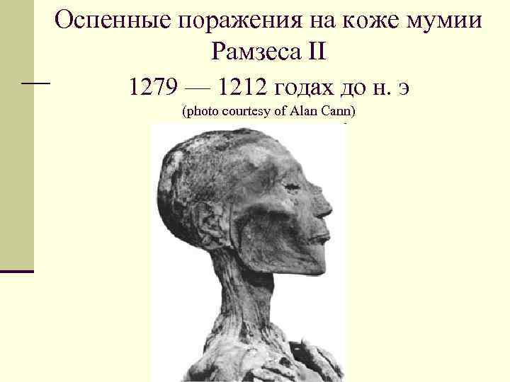 Оспенные поражения на коже мумии Рамзеса II 1279 — 1212 годах до н. э