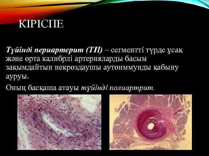 КІРІСПЕ Түйінді периартерит (ТП) – сегментті түрде ұсақ және орта калибрлі артерияларды басым зақымдайтын