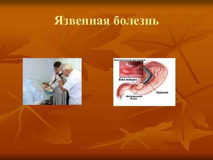 Язвенная болезнь 