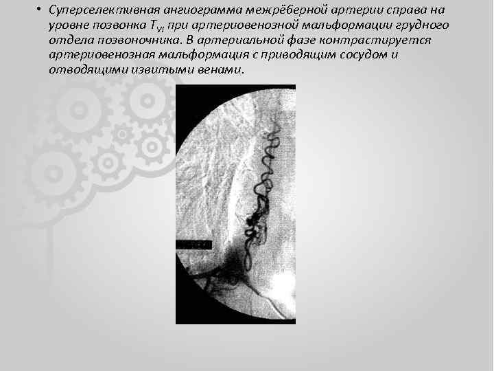  • Суперселективная ангиограмма межрё 6 ерной артерии справа на уровне позвонка TVI при