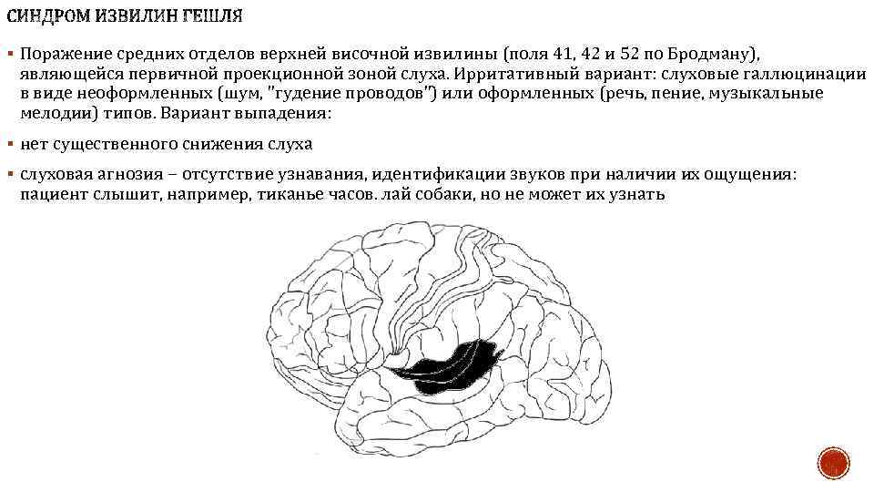 § Поражение средних отделов верхней височной извилины (поля 41, 42 и 52 по Бродману),