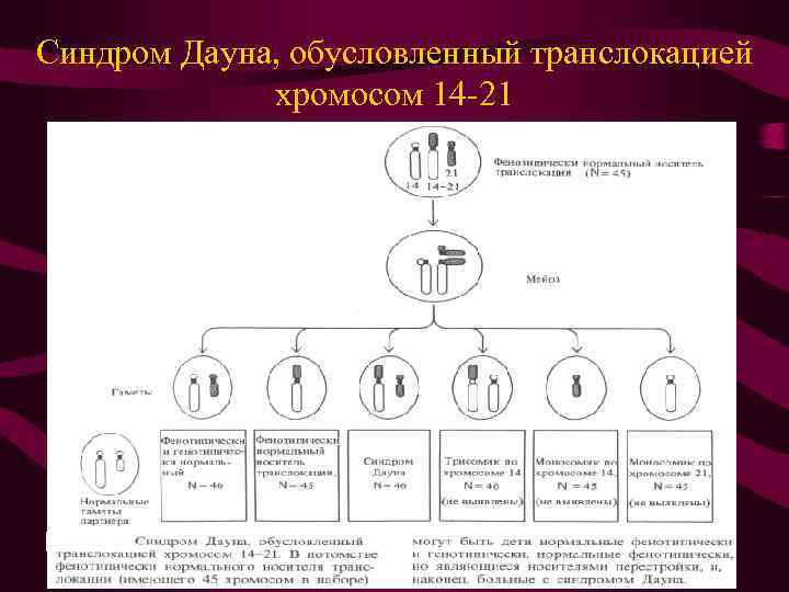 Синдром Дауна, обусловленный транслокацией хромосом 14 -21 