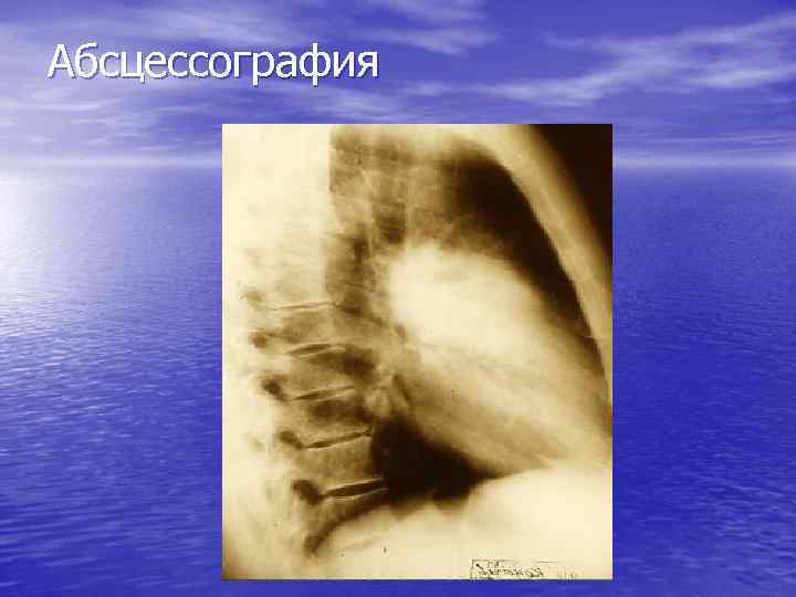Абсцессография 