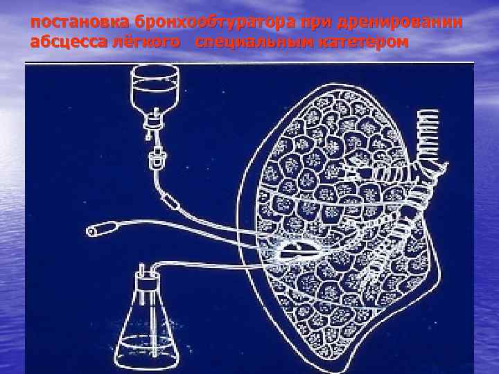 постановка бронхообтуратора при дренировании абсцесса лёгкого специальным катетером 