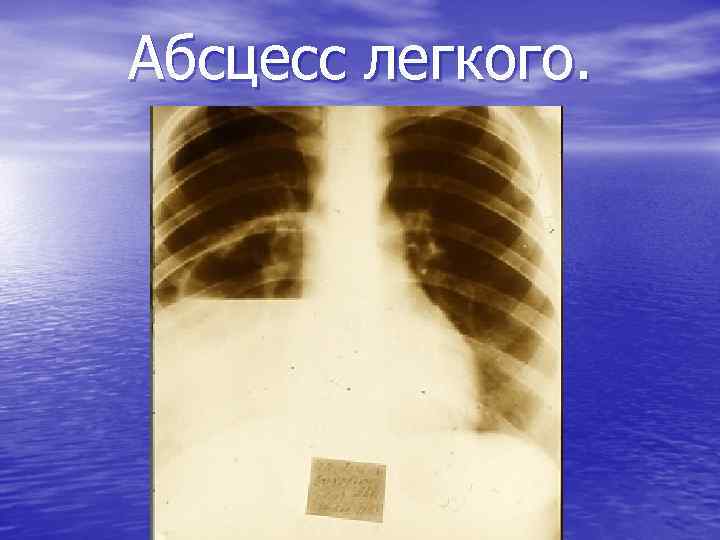 Абсцесс легкого. 