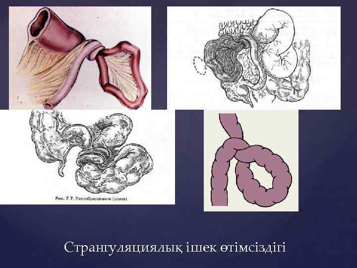 Жедел ішек өтімсіздігі презентация