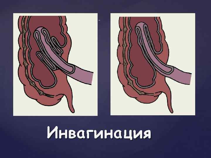 { Схематическое изображение инвагинации тонкой кишки в слепую — двойная инвагинация { Схематическое изображение