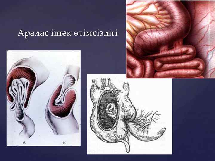Аралас ішек өтімсіздігі 