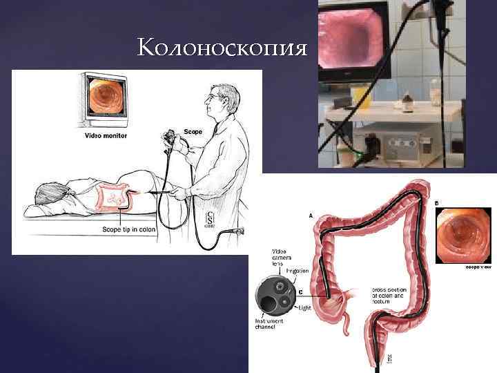 Колоноскопия 