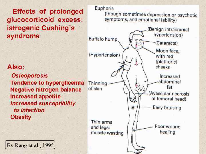 Effects of prolonged glucocorticoid excess: iatrogenic Cushing’s syndrome Also: Osteoporosis Tendence to hyperglicemia Negative