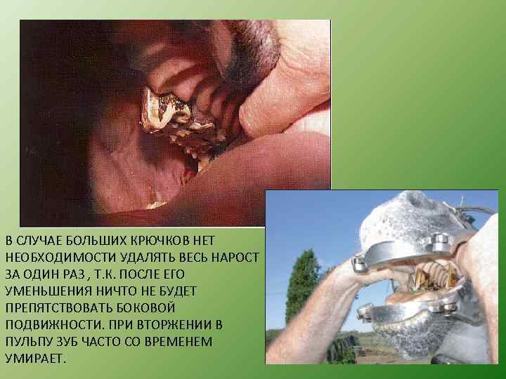 В СЛУЧАЕ БОЛЬШИХ КРЮЧКОВ НЕТ НЕОБХОДИМОСТИ УДАЛЯТЬ ВЕСЬ НАРОСТ ЗА ОДИН РАЗ , Т.