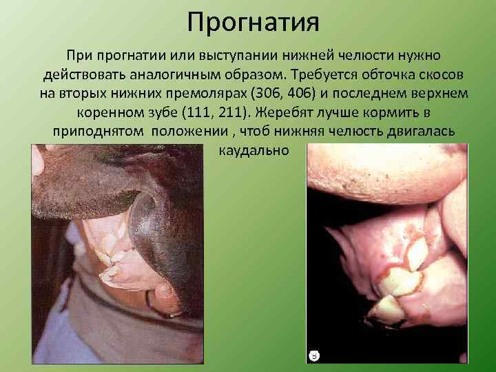 Прогнатия При прогнатии или выступании нижней челюсти нужно действовать аналогичным образом. Требуется обточка скосов