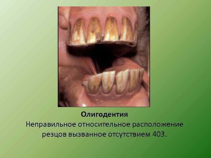 Олигодентия Неправильное относительное расположение резцов вызванное отсутствием 403. 