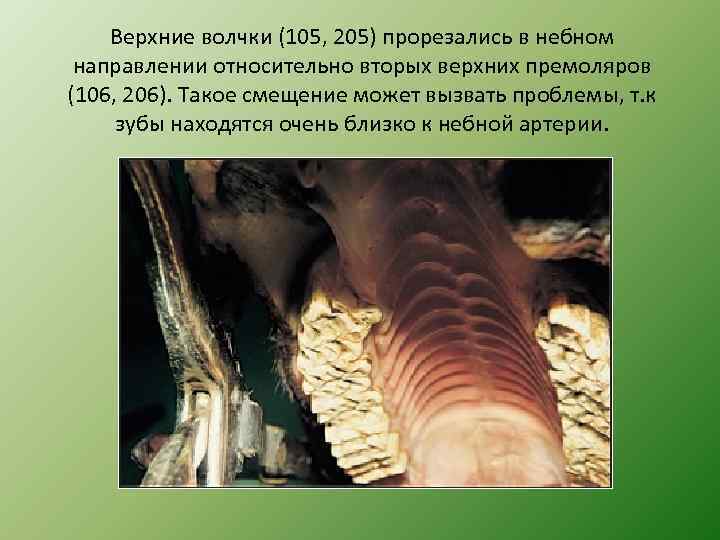 Верхние волчки (105, 205) прорезались в небном направлении относительно вторых верхних премоляров (106, 206).