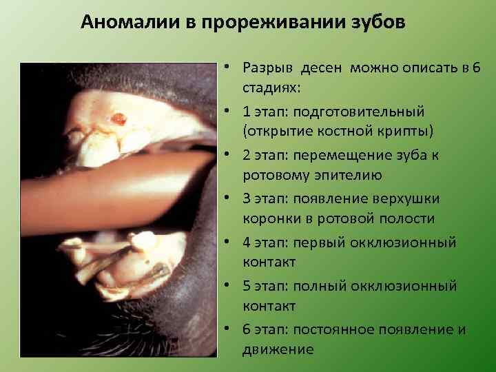 Аномалии в прореживании зубов • Разрыв десен можно описать в 6 стадиях: • 1