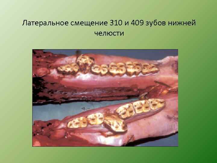 Латеральное смещение 310 и 409 зубов нижней челюсти 