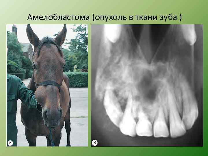 Амелобластома (опухоль в ткани зуба ) 