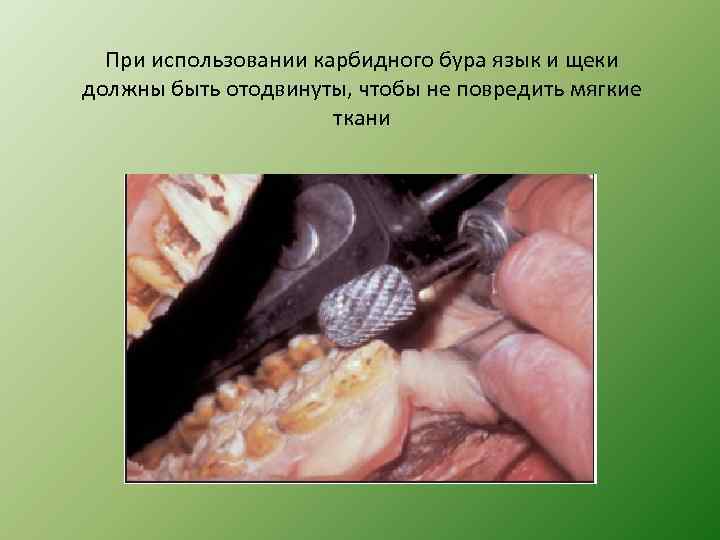 При использовании карбидного бура язык и щеки должны быть отодвинуты, чтобы не повредить мягкие