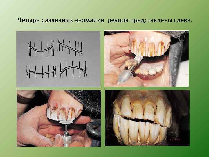 Четыре различных аномалии резцов представлены слева. 