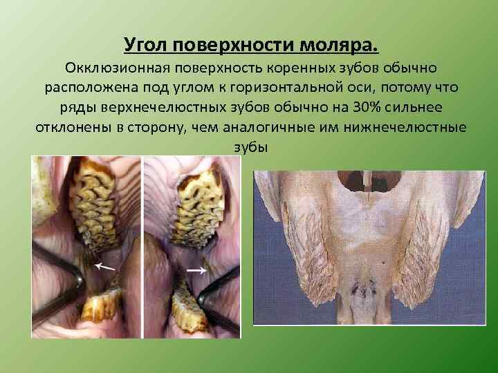 Угол поверхности моляра. Окклюзионная поверхность коренных зубов обычно расположена под углом к горизонтальной оси,